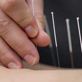 acupuncture